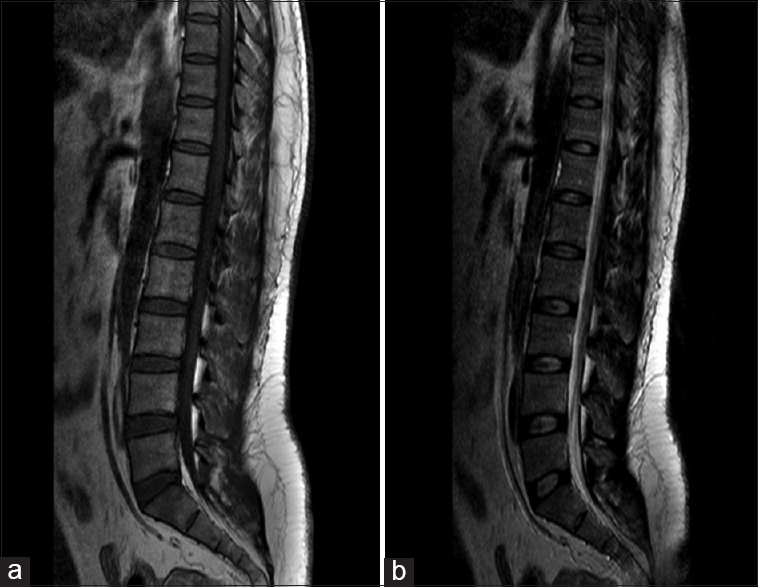 Figure 1: (a) Lumbar spine magnetic resonance images T1-fast spine echo image, (b) lumbar spine magnetic resonance images T2-fast spine echo image