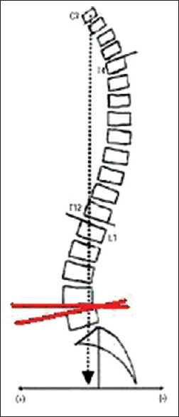 Figure 3: Measurement of the intervertebral disc angle