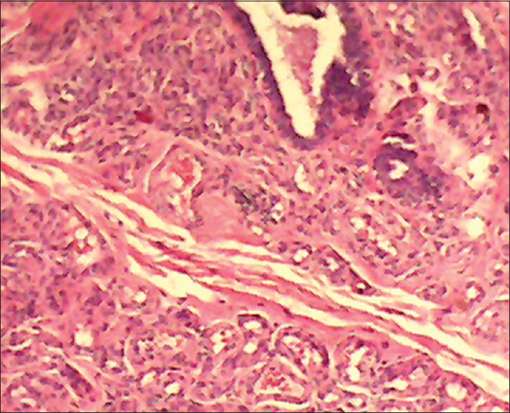 Figure 2: Haemangioma of the breast showing breast ducts at the top right-hand corner with many blood vessels at the bottom of the figure (H and E, ×10)