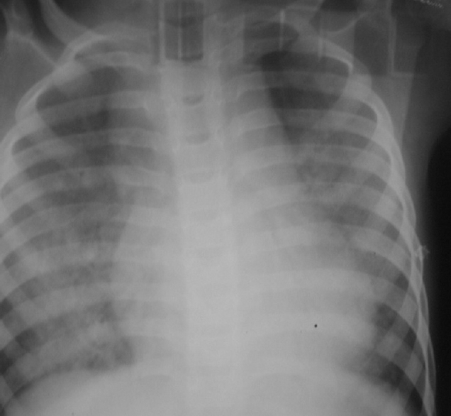 Figure 1: Chest radiograph of a 9-year-old girl with supracardiac total anomalous pulmonary venous connection showing cardiomegaly with widened mediastinum, simulating figure-of-8 appearance