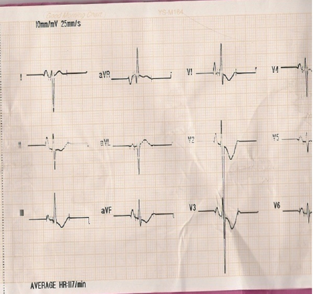 Figure 2: Electrocardiography tracings of the 9-year-old girl with total anomalous pulmonary venous connection. Note the presence of right axis deviation, right atrial enlargement, and right ventricular hypertrophy
