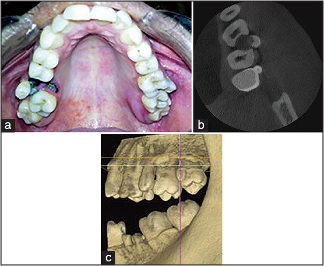 Figure 1: (a) Bilateral paramolar with respect to 16, 26 (b) CBCT image showing the tubercle on mesiobuccal cusp of 28 (c) CBCT image showing no root structure with respect to the tubercle