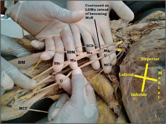 Figure 1: Indicating the absence of musculocutaneous nerve. LC = Lateral cord, MC = Medial cord, Mn = Median nerve, U = Ulnar, BCB = Muscular branch to coracobrachialis, McF = Medial cutaneous nerve of forearm, BBM = Muscular branch to biceps brachii muscle, BBr = Branch for brachialis, BM = Biceps brachii muscle, LRMn = Lateral root of median nerve, MRMn = Medial root of median nerve, McN = Musculocutaneous nerve