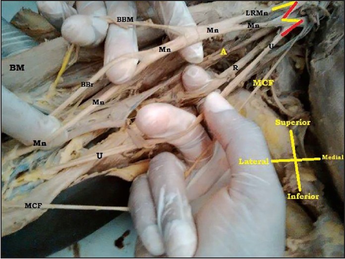 Figure 2: Indicating the absence of musculocutaneous nerve. LC = Lateral cord, MC = Medial cord, Mn = Median nerve, U = Ulnar nerve, BCB = Muscular branch to coracobrachialis, R = Radial nerve, MCF = Medial cutaneous nerve of forearm, BBM = Muscular branch to biceps brachii muscle, A = Axillary nerve, BBr = Branch to brachialis, BM = Biceps brachii muscle, LRMn = Lateral root of median nerve