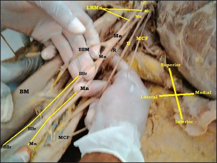 Figure 3: Indicating the absence of musculocutaneous nerve. LC = Lateral cord, MC = Medial cord, Mn = Median nerve, U = Ulnar nerve, BCB = Muscular branch to coracobrachialis, R = Radial nerve, MCF = Medial cutaneous nerve of forearm, BBM = Muscular branch to biceps brachii muscle, A = Axillary nerve, BBr = Branch to Brachialis, BM = Biceps brachii muscle, LRMn = Lateral root of median nerve, MRMn = Medial root of median nerve