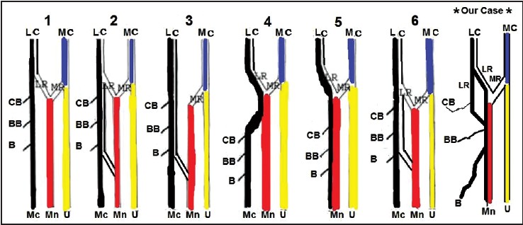 Figure 5: Showing illustrations of six types of the musculocutaneous and the median nerves (I-VI) and our case (*). LC = Lateral cord, MC = Medial cord, MC = Musculocutaneous nerve, Mn = Median nerve, U = ulnar nerve, CB = Coracobrachialis muscle, BB = Biceps brachii muscle, B = Brachialis muscle, LR = Lateral root of median nerve, MR = Medial root of median nerve