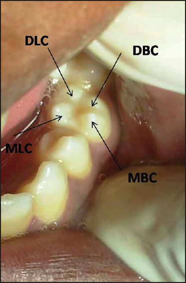 Figure 3: Naming of each cusp in the premolar (MBC = Mesiobuccal cusp, DBC = Distobuccal cusp, DLC = Distolingual cusp, MLC = Mesiolingual cusp)