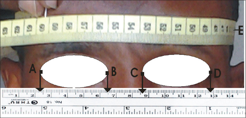 Figure 1: Measurements of head circumference and canthal distances E=Head circumference; BC=Inner canthal distance; AD=Outer canthal distance