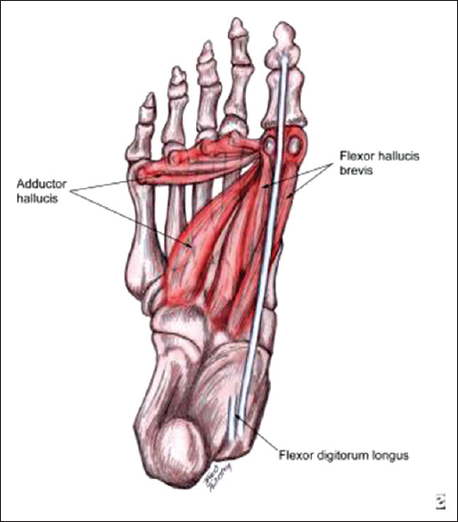 Figure 3: Some structures associated with hallux valgus