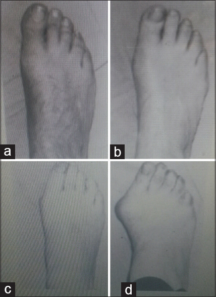 Figure 5: Hallux valgus grading photographs showing the various degrees of deformity. (a) no deformity (b) mild deformity (c) moderate deformity (d) severe deformity