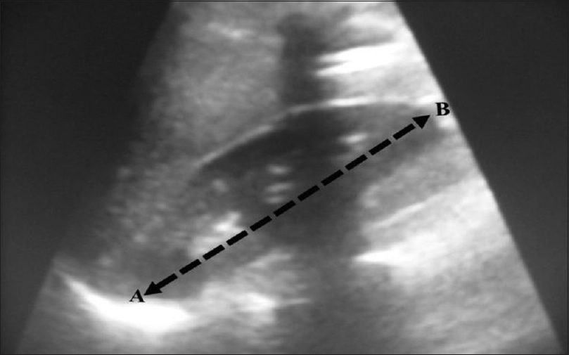 Figure 1: Longitudinal ultrasound scan of the right kidney showing measurement of its length (AB)