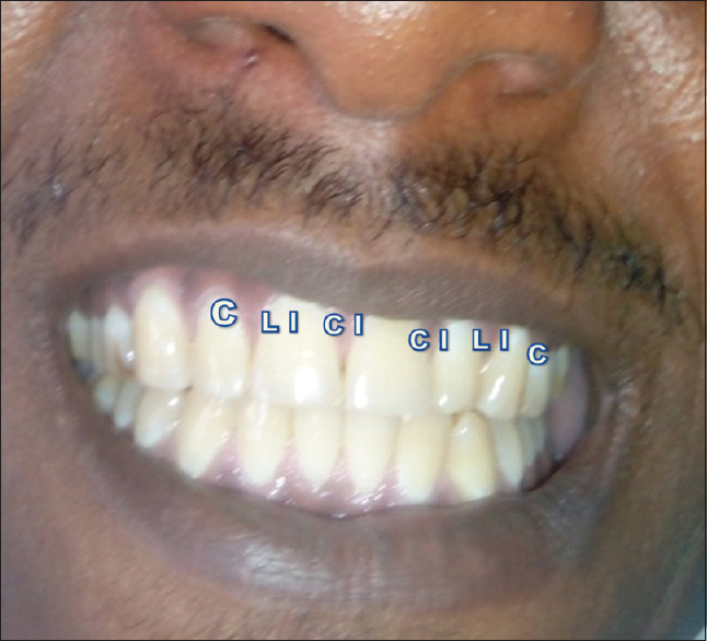 Figure 6: Six maxillary anterior teeth measured. CI = Central incisor, LI = Lateral incisor, C = Canine