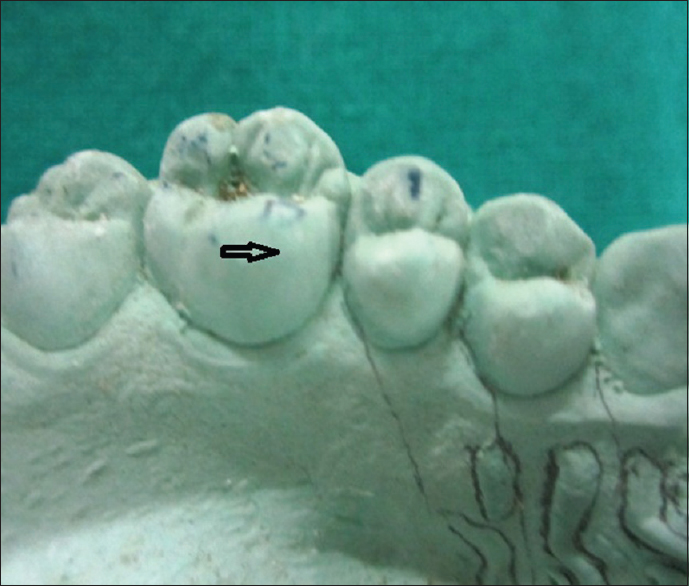 Figure 1: Smooth mesiobuccal crown surface