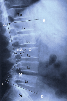 Figure 2: Measurement of the lumbar lordosis angle – lumbar lordotic angle (α)