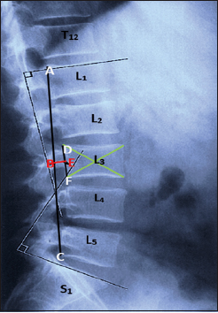 Figure 3: Measurement of the lumbar lordosis depth – lumbar lordotic depth (B-E)