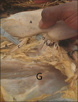 Figure 2: The posterior surface of the left kidney as it is pulled away from the paravertebral gutter, together with the structures entering and leaving the substance of the kidney (A: Left kidney; B: Left ureter; C: First accessory renal artery; D: Main renal artery; E: Second accessory renal artery; F: Third accessory renal artery; G: Left paravertebral gutter)
