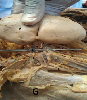 Figure 3: The posterior surface of the right kidney as it is reflected medially away from the right paravertebral gutter together with the structures entering and exiting the substance of the kidney (A: Right kidney; B: Main renal artery; C: First presegmental artery; D: Second presegmental artery; E: Third presegmental artery; F: Abdominal aorta; G: Right paravertebral gutter; H and I: First and second renal veins, respectively; J: Right ureter)