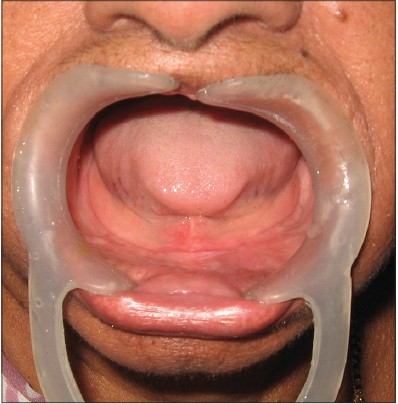 Figure 1: Grossly resorbed mandibular ridge