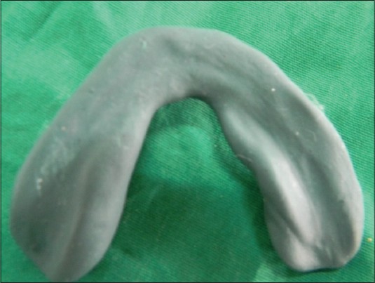 Figure 2: Final mandibular impression with admixed compound