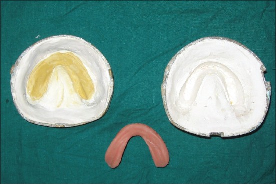 Figure 3: Lower denture with permanent silicone soft liner