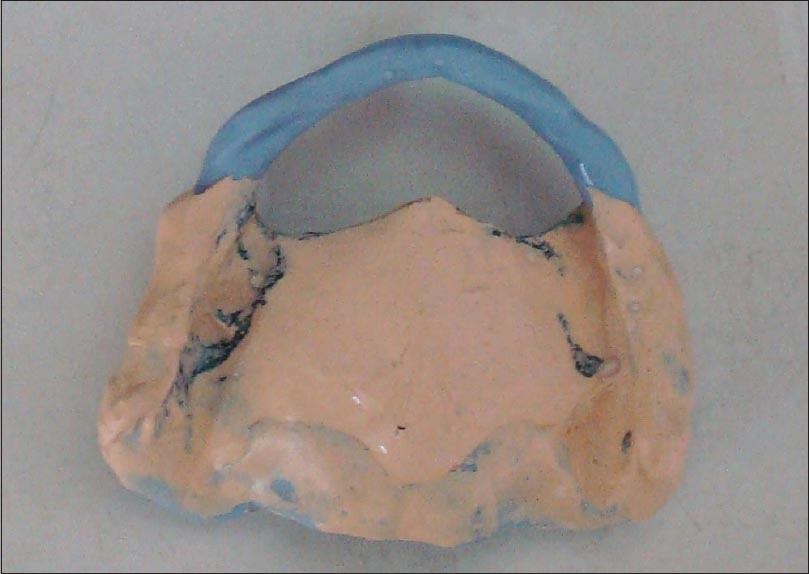 Figure 4: Wash impression of normal tissue in a windowed tray