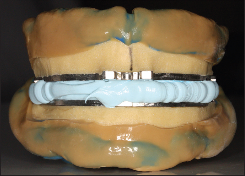 Figure 2: Final impression and recording of the maxillomandibular relationship