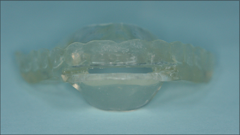 Figure 5: Oral appliance of primary snoring patient
