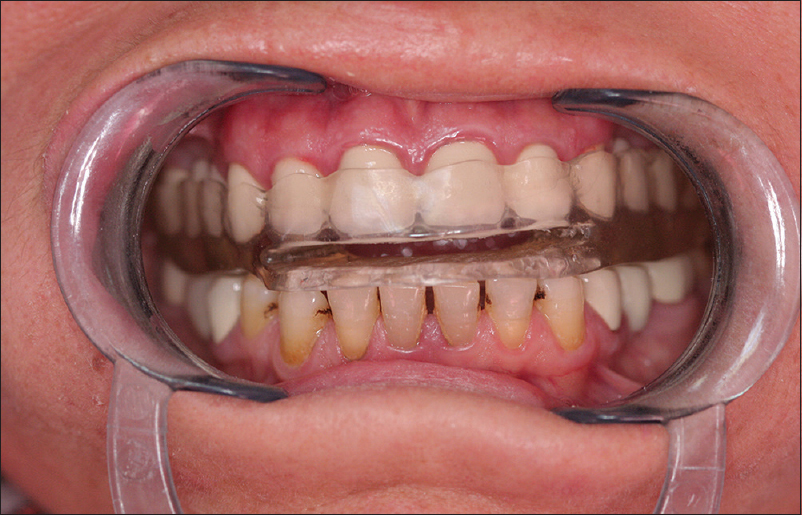 Figure 6: Intermaxillary relation with oral appliance