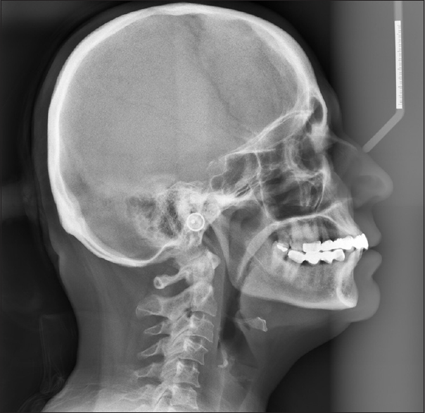 Figure 7: Lateral cephalometric radiograph without appliance