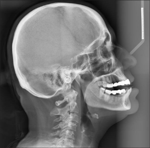 Figure 8: Lateral cephalometric radiograph with appliance