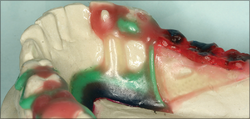 Figure 3: Wax pattern is made for a removable partial denture framework with the cingulum rest with small hole on the refractory cast