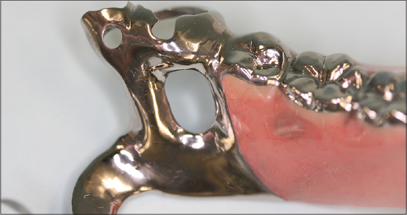 Figure 4: The removable partial denture is completed by casting, resin polymerization, and polishing