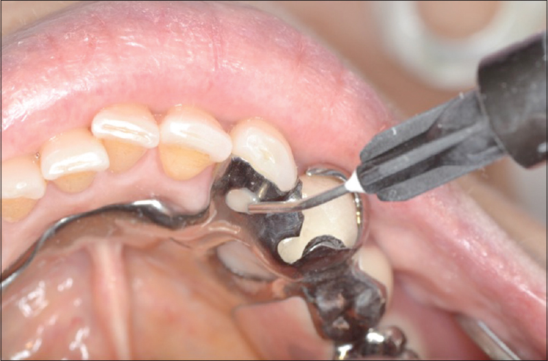 Figure 6: Bonded-composite resin is injected through the hole into the space between the lingual surface of abutment tooth and the inner surface of the lingual rest and polymerized by visible light under occlusal force