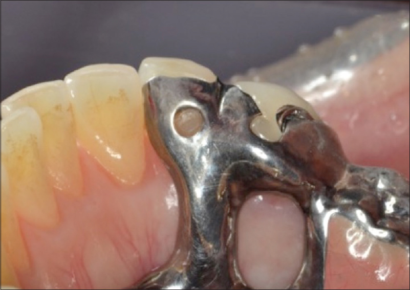 Figure 7: The composite resin is polymerized using visible light under occlusal force
