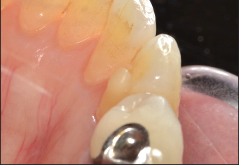 Figure 8: Removable partial denture is removed from the mouth and the bonded resin of the cingulum rest seat is lightly polished