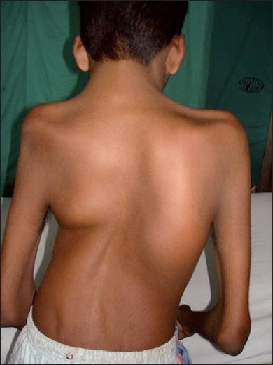 Figure 2: Pterygium of the neck and scoliosis