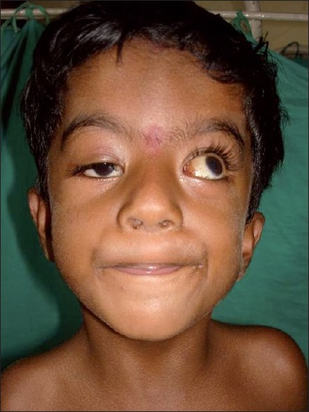 Figure 6: Right ptosis, epicanthic fold, anti mongoloid slant, and receding chin