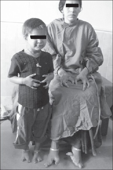 Figure 1: Mother and elder sibling with typical limb deformities.