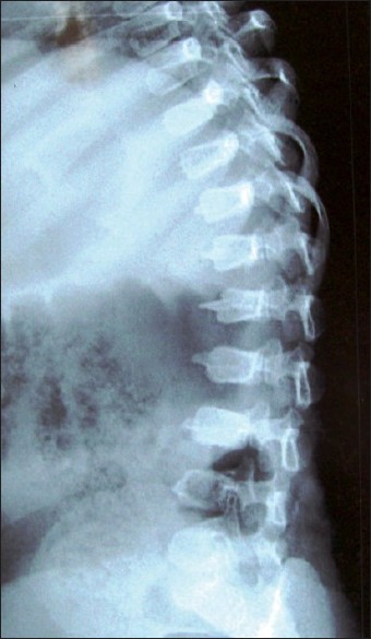 Figure 1: Skiagram of the spine (lateral view) showing platyspondyly, pear-shaped vertebrae with anterior beaking of T12 to L4 vertebrae