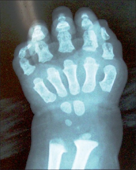 Figure 2: X-ray of wrist with hand revealed irregular ulnar and radial metaphysis, short tubular metacarpals, short phalanges, and conical distally tapering middle phalanges.