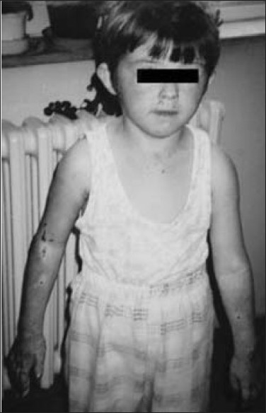 Figure 1: Age 6 years: facial appearance, blistering and scarring on the hands