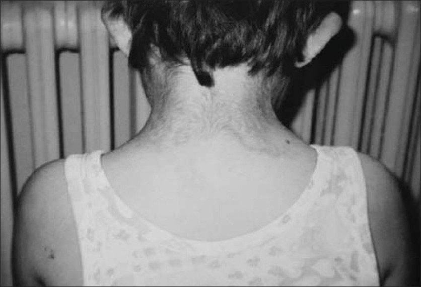 Figure 3: Age 6 years: Hypertrichosis on the back of the neck