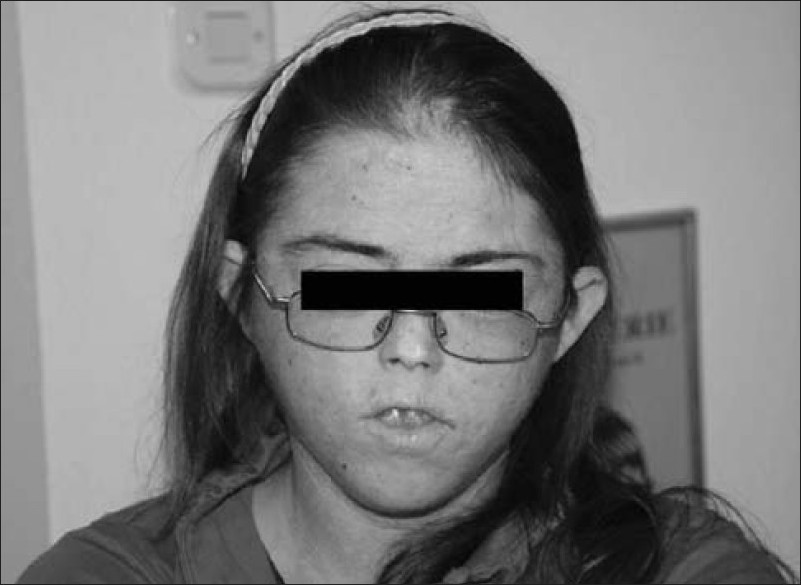 Figure 4: Age 14 years: facial appearance