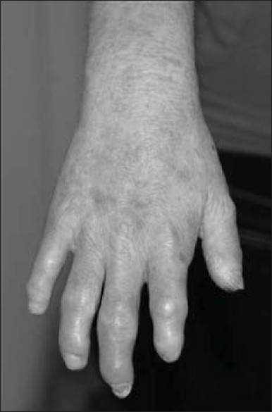Figure 5: Age 14 years: the hands, scarring, arthrogryposis