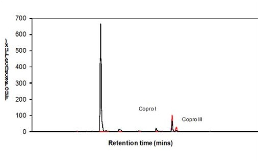 Figure 6: HPLC fractionation pattern of urine (blank trace) and fecal (red trace) porphyrin methyl esters. Uro I: uroporphyrin octamethyl ester isomer I, Copro I: coproporphyrin tetramethyl ester isomer I and Copro III: coproporphyrin tetramethyl ester isomer III.
