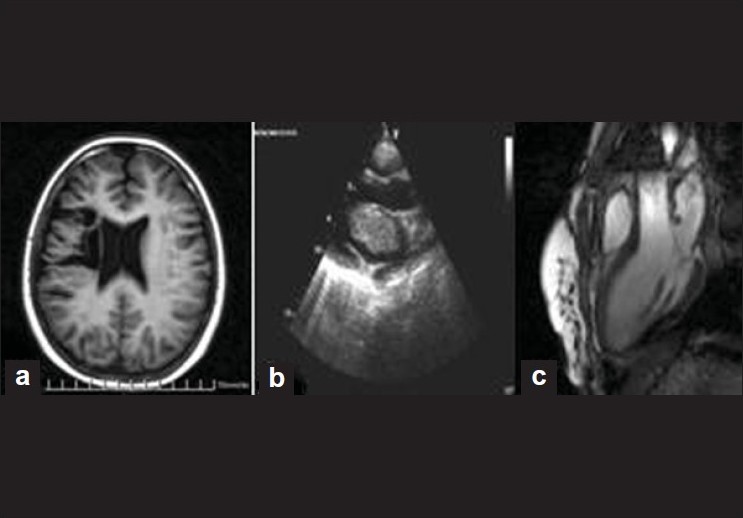Figure 1: (a) computed tomography brain scan. (b) Cardiac Heart ultrasound of primary myxoma. (c) nuclear magnetic resonance imaging of recurrent myxoma