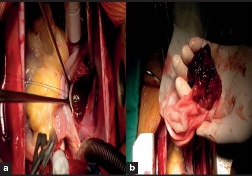 Figure 2 : (a) Intraoperative view of the tumor (b) The enucleated myxoma