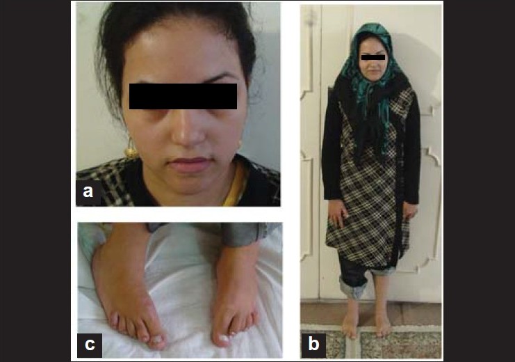 Figure 1: (a) Mother with low set ears. (b) Short stature. (c) Club feet.
