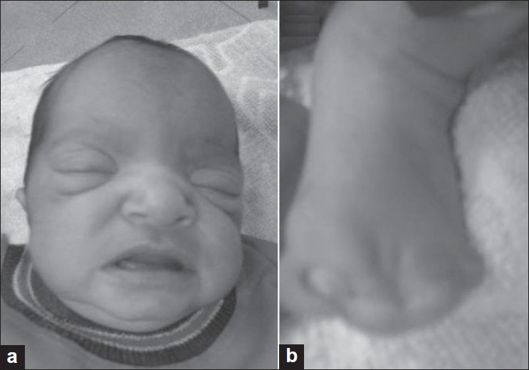 Figure 1: Photograph of the face (a) in a case of Apert syndrome showing prominent forehead, hypertelorism, proptosis, low set ears, and open mouth. The child also had mitten hands. The feet with extensive syndactyly are shown in (b)