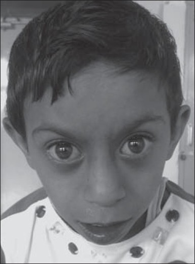 Figure 2: Case clinically diagnosed as Saethre-Chotzen syndrome. She had short stature, mental retardation, triangular faces, prominent eyes, low set ears, short neck, brachydactyly, and cyanotic heart disease